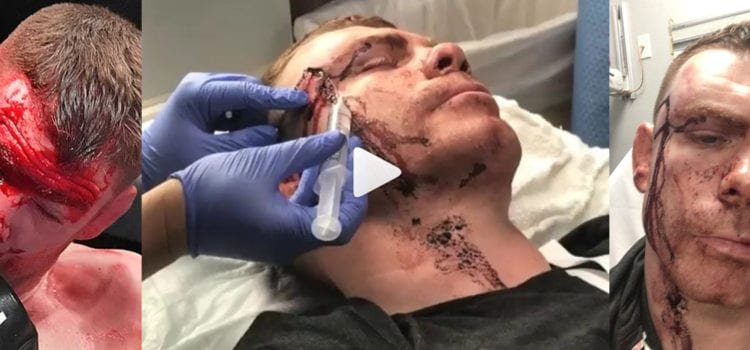 Video: El tratamiento al brutal corte de Paul Felder