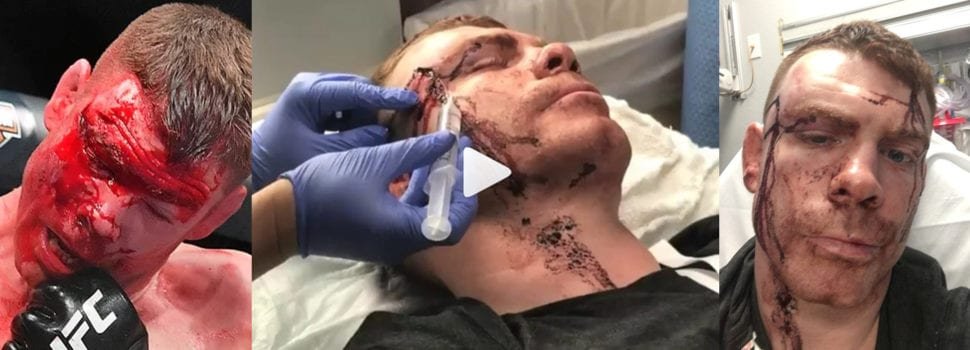Video: El tratamiento al brutal corte de Paul Felder