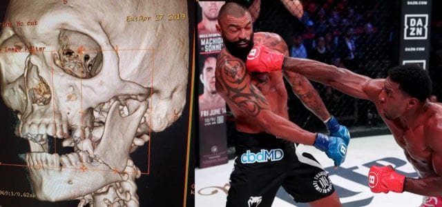 Liam McGeary presume su mandíbula rota en la derrota ante Phil Davis