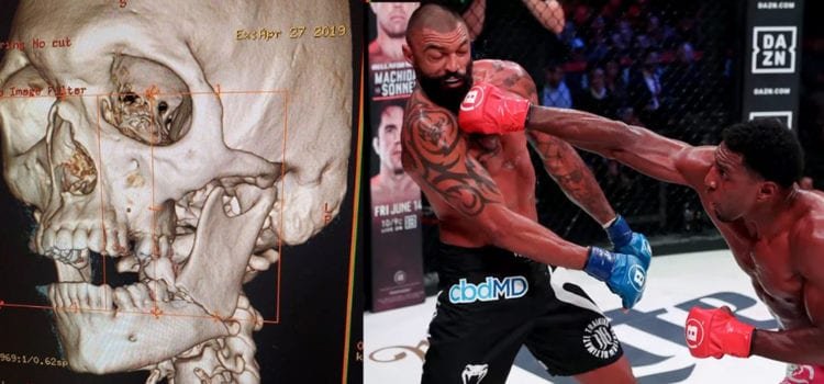 Liam McGeary presume su mandíbula rota en la derrota ante Phil Davis