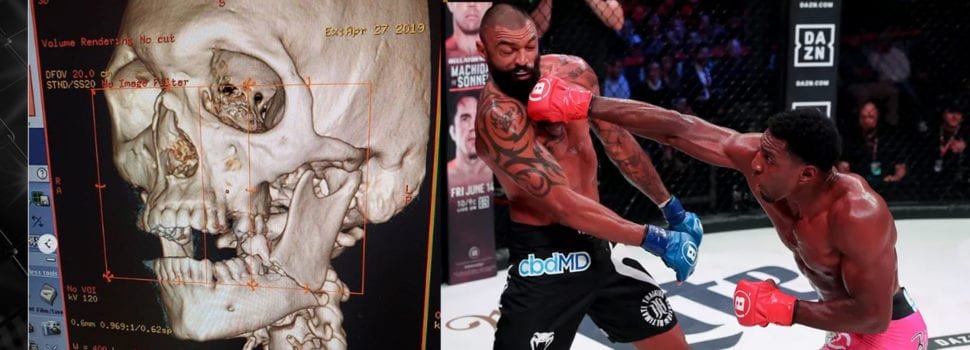 Liam McGeary presume su mandíbula rota en la derrota ante Phil Davis