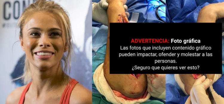 VanZant comparte terribles imágenes de su brazo tras la última cirugía